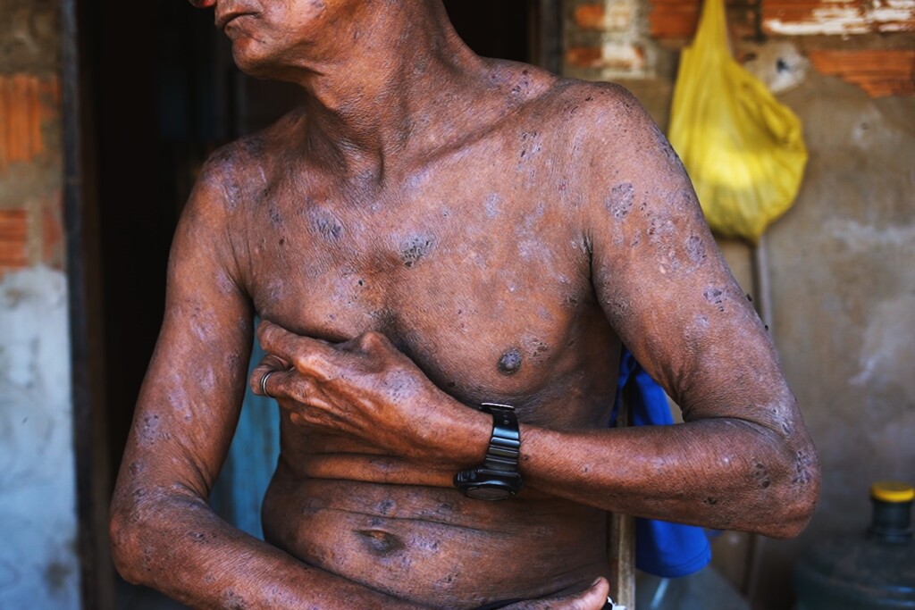 Trabalhador da fruticultura que manuseia agrotóxicos e fertilizantes exibe feridas pelo corpo. Foto: Tatiana Cardeal/Divulgação Papel Social.